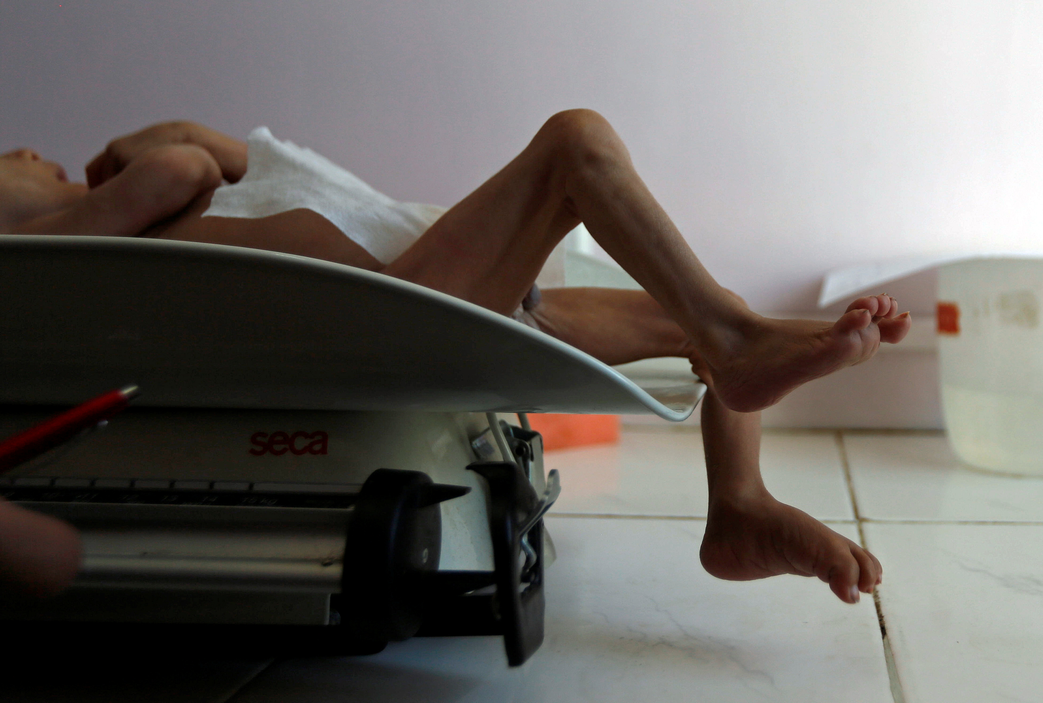 A boy lies on a weighing scale at a malnutrition treatment center in Sanaa, Yemen