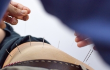 closeup of an acupuncturist's hands inserting needles