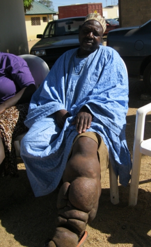 Faces Of Elephantiasis In Nigeria Patients Remain After The