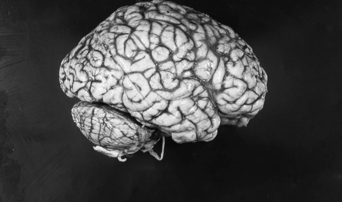 Is Football Bad for Your Brain? The World from PRX