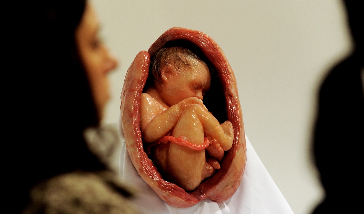 Aussie Hospital Mistakenly Aborts Wrong Twin Fetus The World From Prx