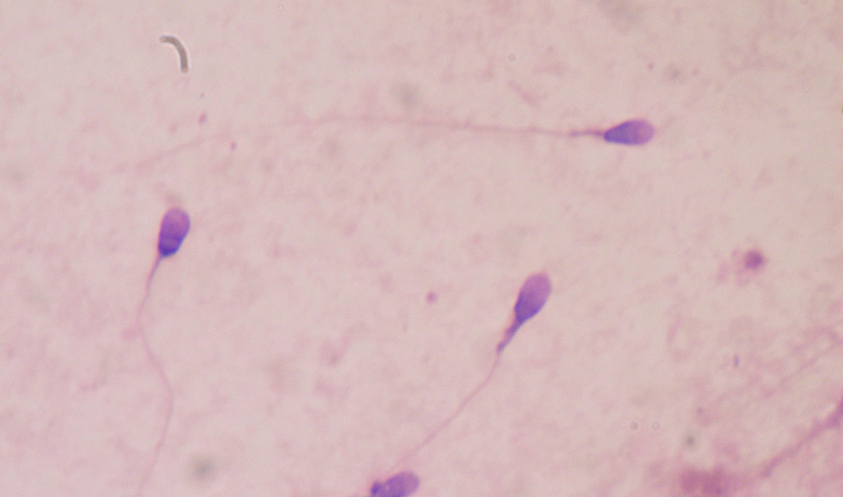 Denmark Shock after sperm donor gives 5 babies rare disease