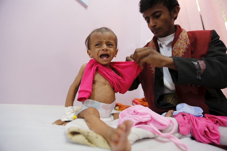 A man dresses his malnourished daughter at a malnutrition intensive care unit in Yemen A man dresses his malnourished daughter at a malnutrition intensive care unit in Yemen