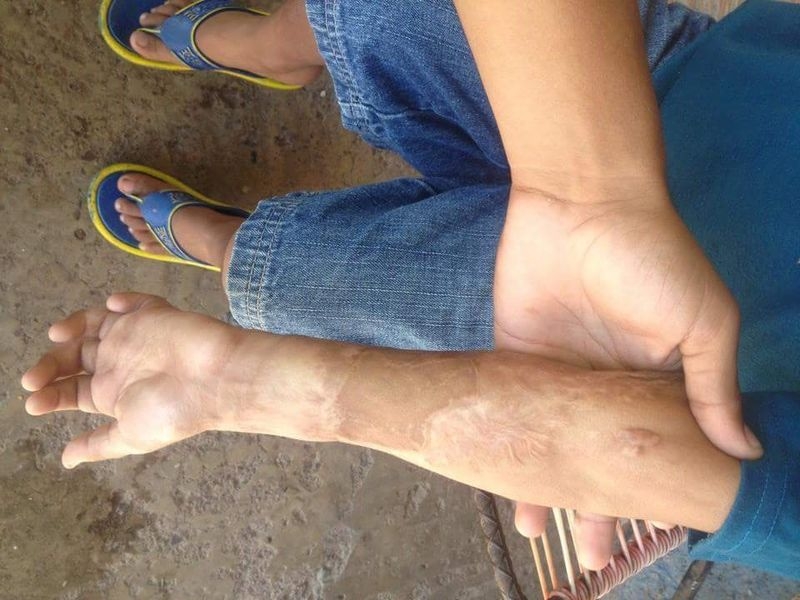 Burn marks Burn marks