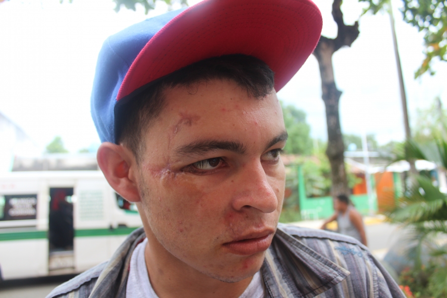 a nicaraguan man shows the scars from being beaten up by pro-government forces