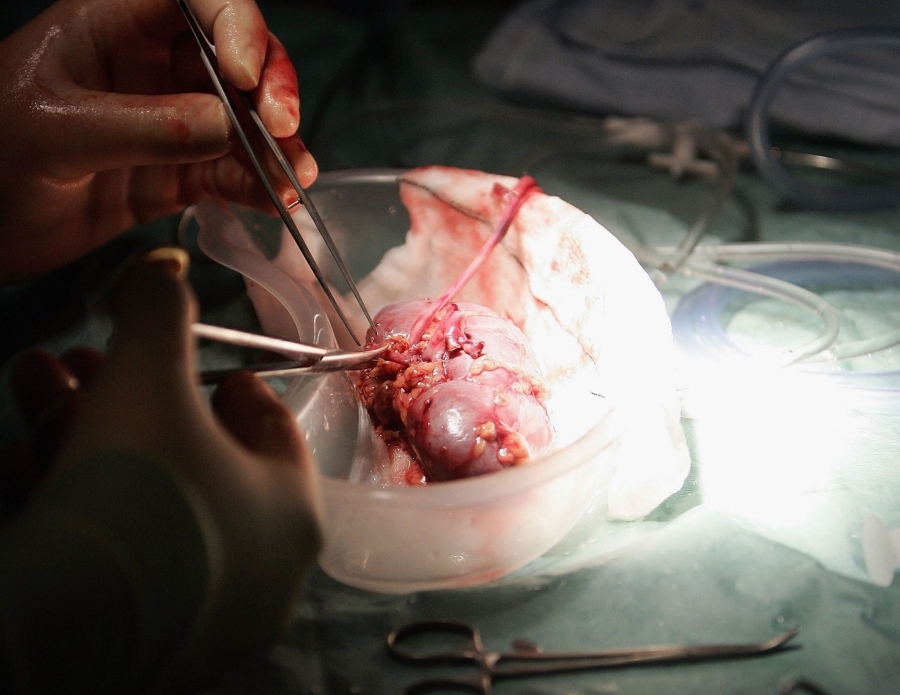 Donor kidneys are viable for transplant for only a short time. A closeup look at a surgeon's hands and a human kidney.