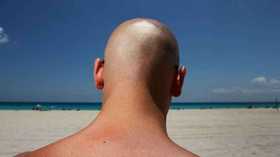 Climate change might lead to more skin cancer, says study The World