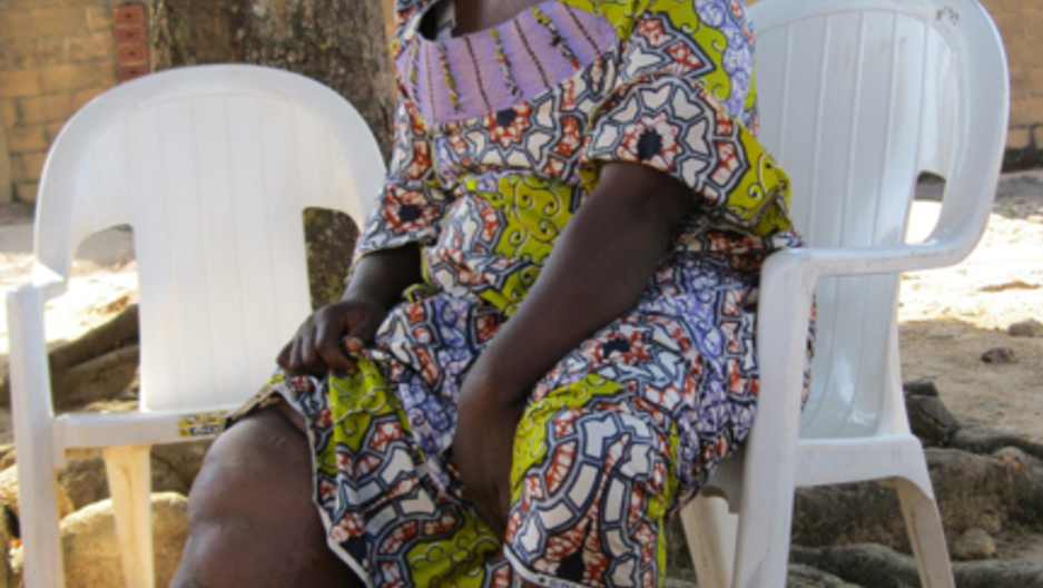 Faces Of Elephantiasis In Nigeria Patients Remain After The