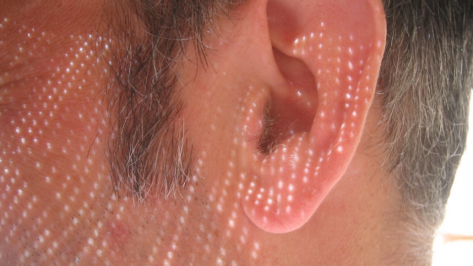 This New Treatment Could Combat Hearing Loss By Regenerating Hair
