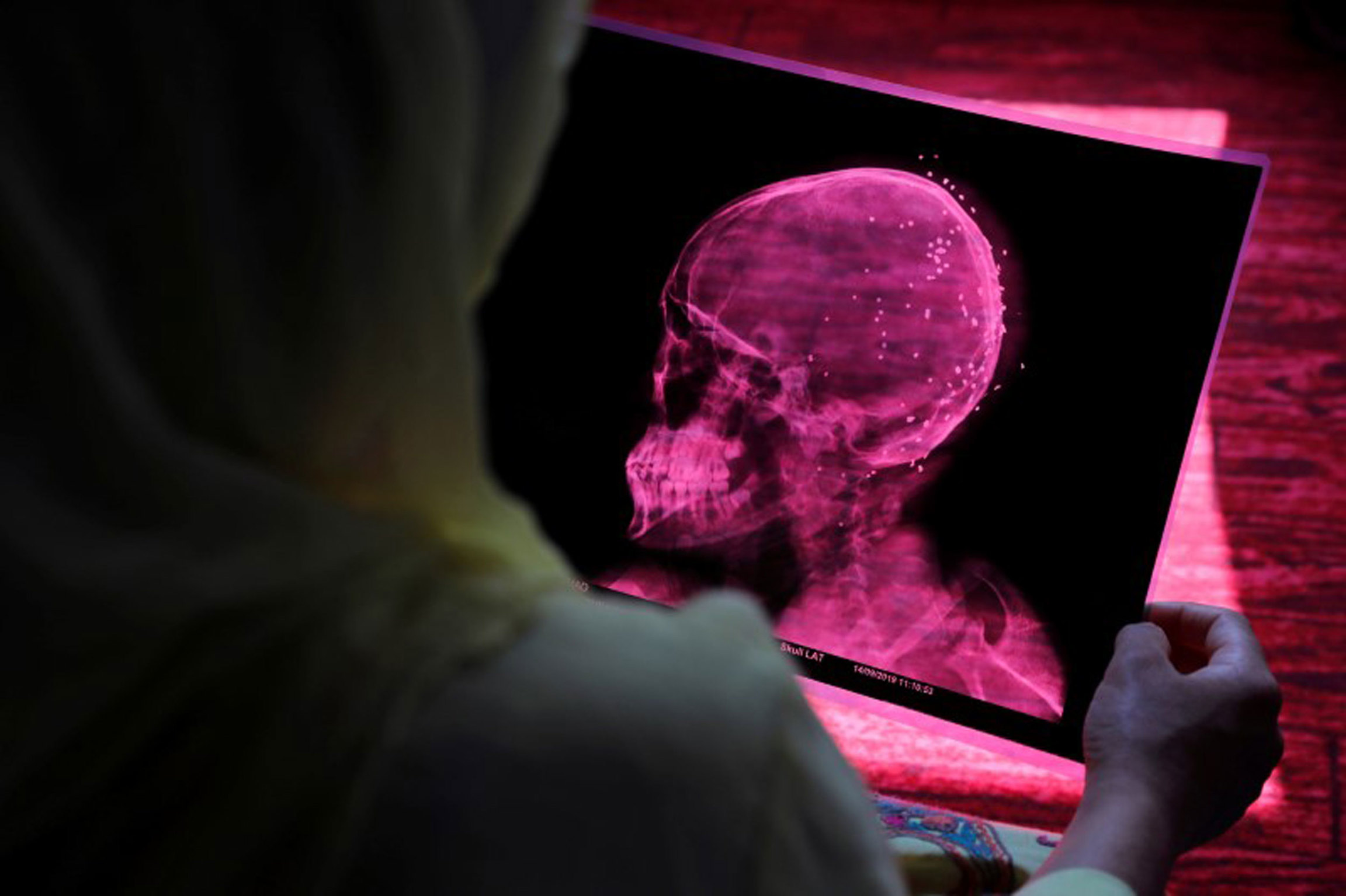 Rubina shows her son's x-ray. A woman is shown from over her shoulder holding a pink colored X-ray