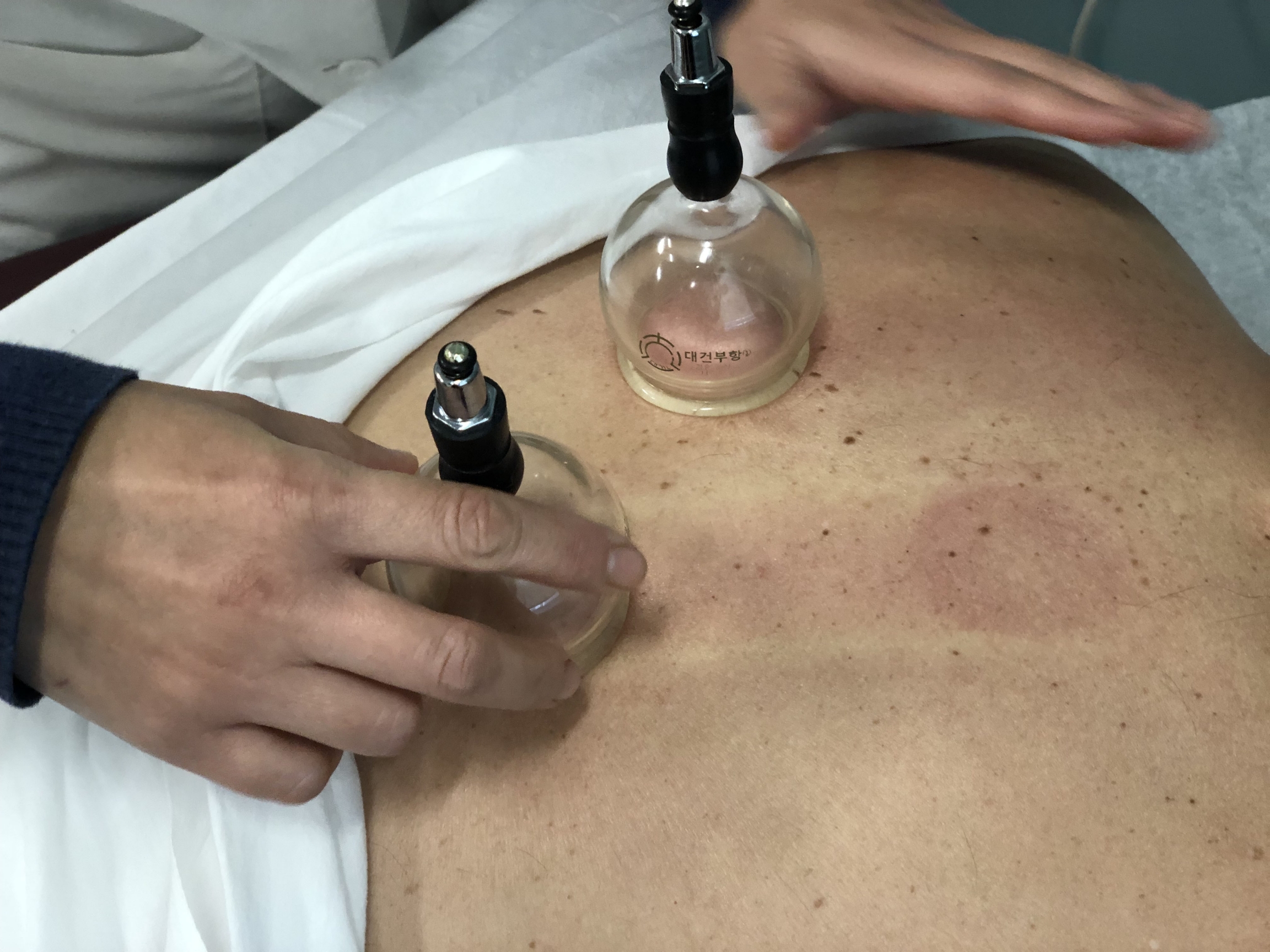 Quan Zhou, a traditional Chinese medicine practitioner, performs a cupping procedure on a patient's back at the New England School of Acupunctu Quan Zhou, a traditional Chinese medicine practitioner, performs a cupping procedure on a patient's back at the New England School of Acupunctu
