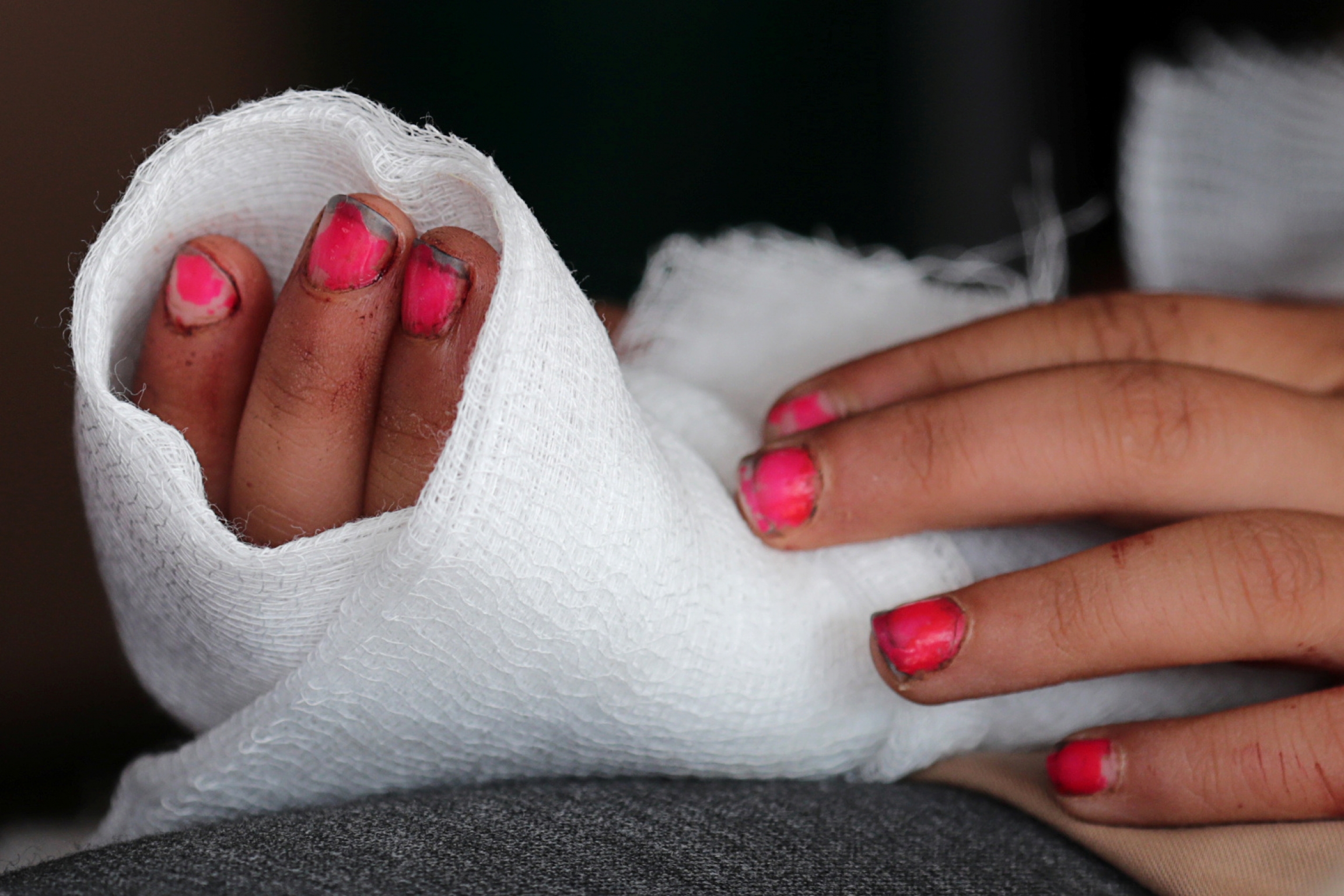 The fingers of a wounded girl are seen in the town of Tal Abyad, Syria, Oct. 20, 2019. Hands with pink nail polish are wounded and bandaged