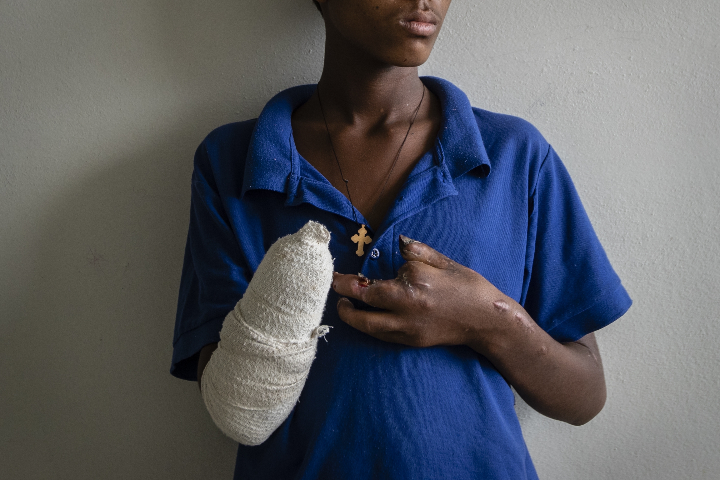 Haftom Gebretsadik, a 17-year-old from Freweini near Hawzen who had his right hand amputated and lost fingers on his left after an artillery round struck his home in March. Boy wearing blue has bandage around arm area from losing his hand and fingers.